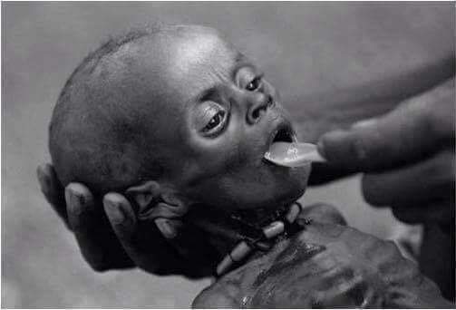 Đây là hình ảnh 1 em bé châu Phi có nguy cơ chết đói, đang được những tình nguyện viên chăm sóc để phục hồi sức khỏe nhưng với thể trạng như vậy, liệu em có thể qua khỏi?